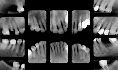 Serie Periapical