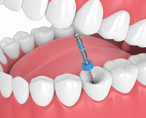 Endodoncia