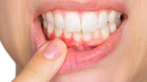 Periodoncia