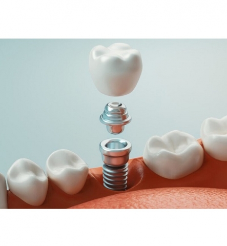 Implantes Dentales