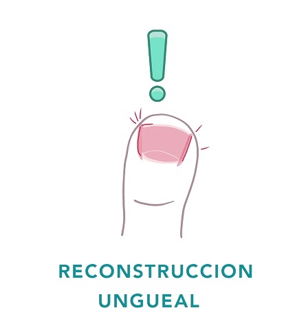RECONSTRUCCI&Oacute;N UNGUEAL